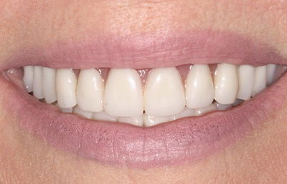 Closeup of smile after treatment